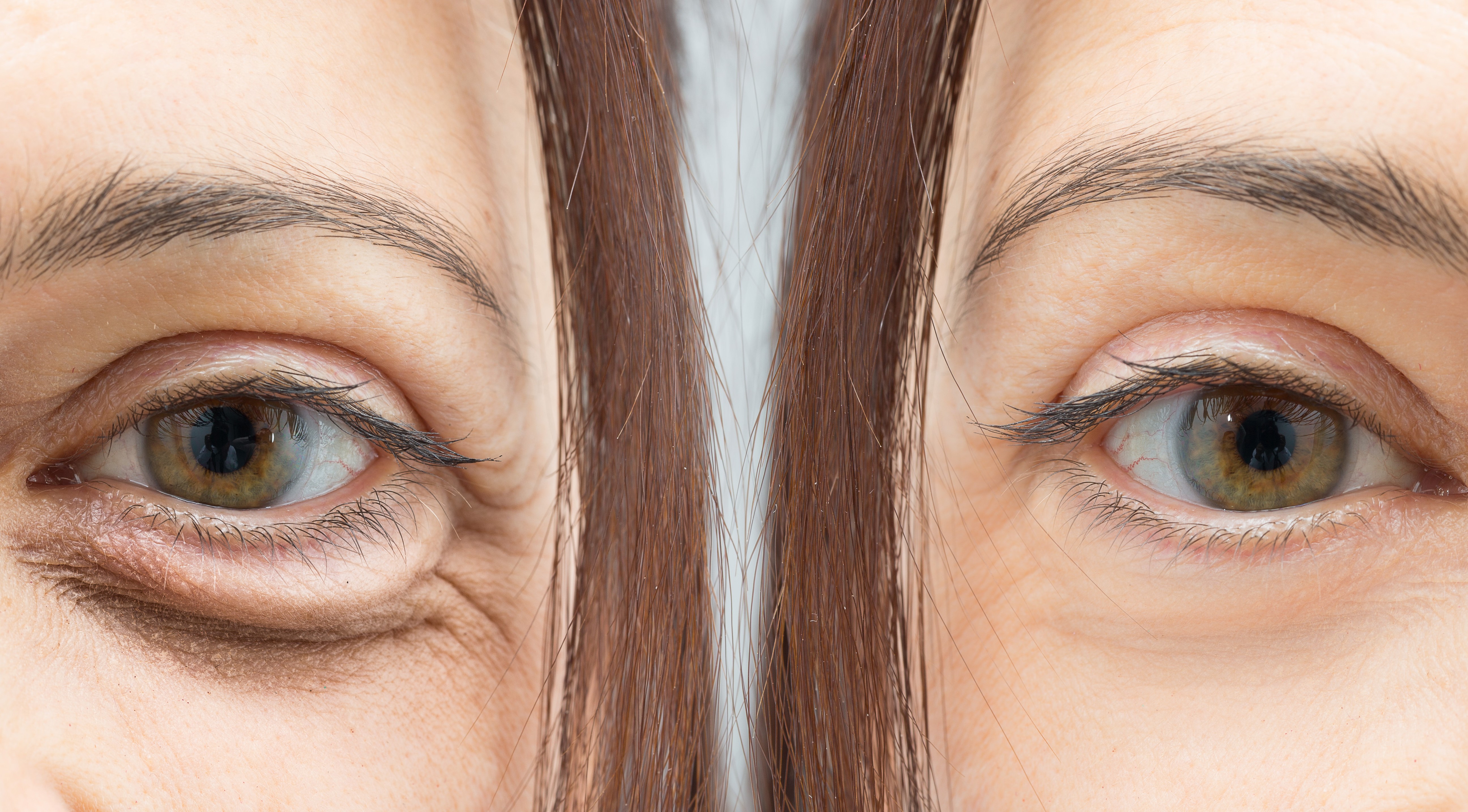 блефаропластика глаз фото до и после
